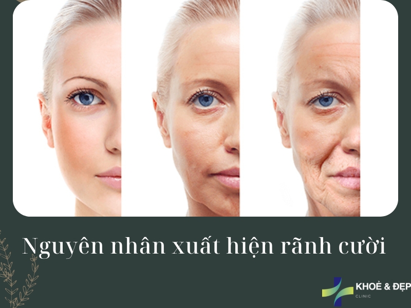 Vì sao cần phải giảm béo mặt? Vì sao cần phải giảm béo mặt?