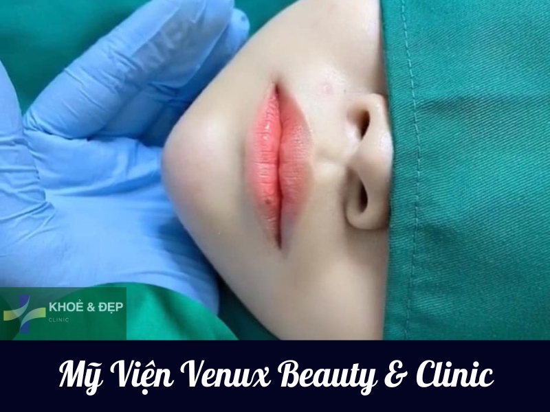Mỹ Viện Venux Beauty & Clinic- Địa chỉ tiêm HA uy tín tại Buôn Ma Thuột